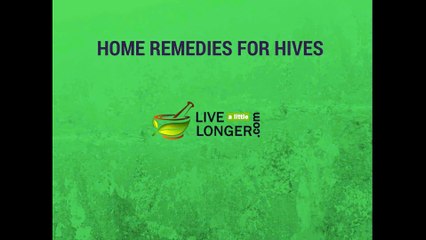 Remedies for hives