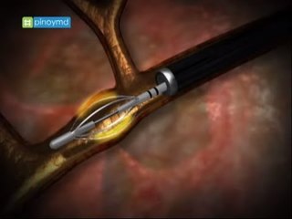 Bronchial thermoplasty for asthma patients | Pinoy MD