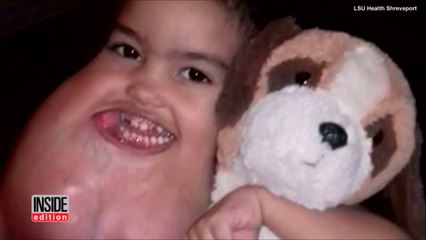 Cet enfant de 3 ans se fait opérer d'une tumeur au visage énorme!