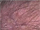 HAIR RESTORATION DALLAS:  CROWN TRANSPLANT 1 DAY OUT