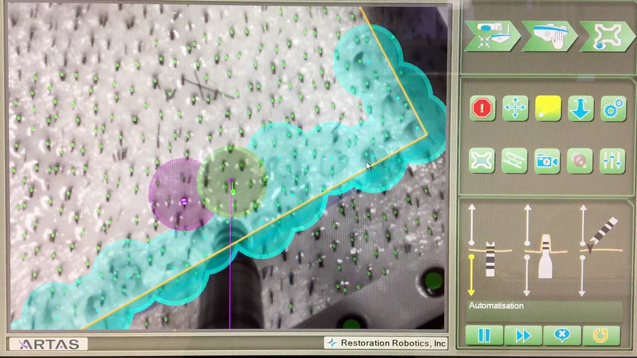 Prélèvement_implants_capillaires_Artas1_The Clinic Paris