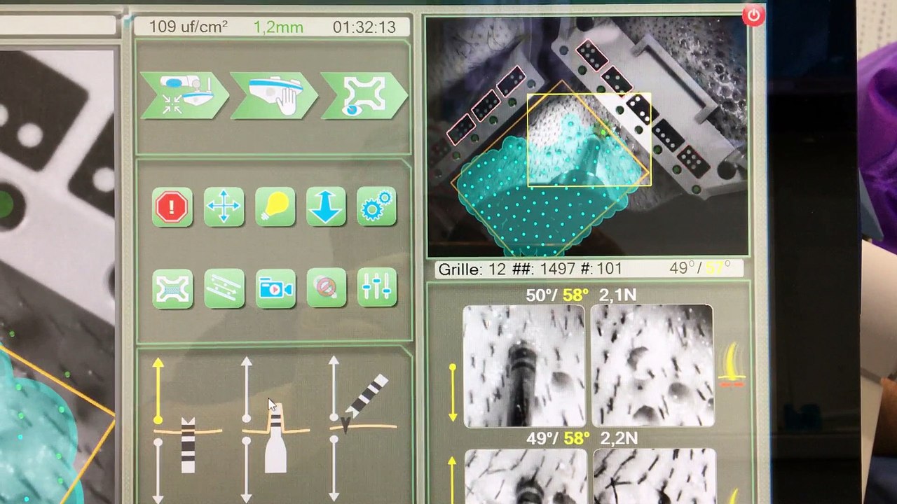 Prélèvement_implants_capillaires_Artas3_The Clinic