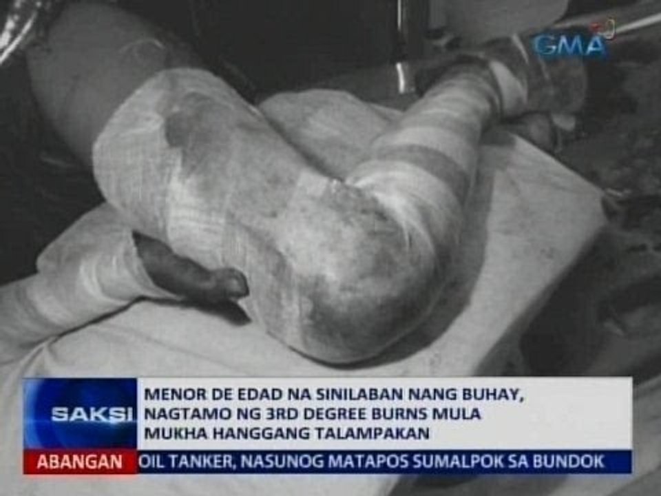 SAKSI: Menor de edad na sinilaban ng buhay, nagtamo ng 3rd degree burns