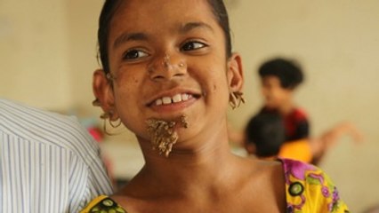 Una niña bangladesí, diagnosticada con la enfermedad del "hombre árbol"