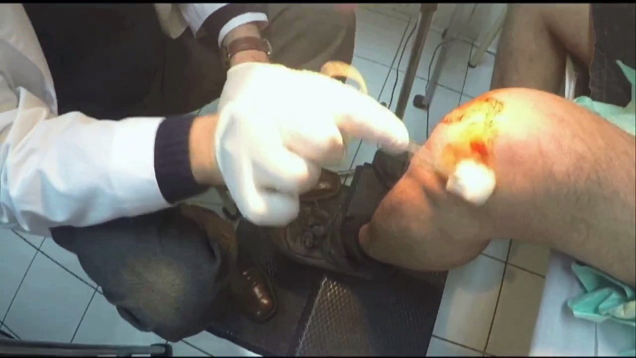OZONOterapia en artrosis de rodilla  dr manuel diaz diaz