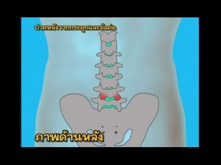 ชิดหมอ ..( Ep.42 ).. ตอน "ปวดหลัง"