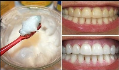 How To Whiten Your Yellow Teeth Naturally At Home