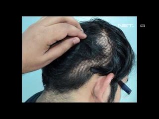 Entertainment News - Hair Transplant