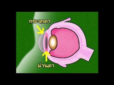 ตะลุยโรงหมอ เทป 26 .. ( ตอน ต้อกระจก )