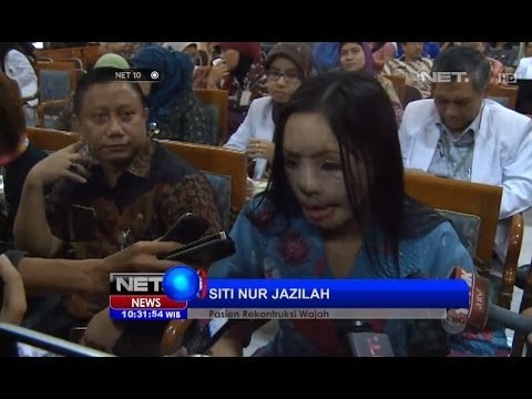 NET5 - Siti Nur Jazilah Pasien Rekonstruksi Wajah Pulang Setelah Dirawat 7 tahun