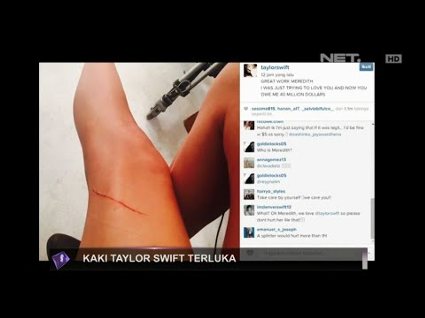 Kaki Taylor Swift terluka