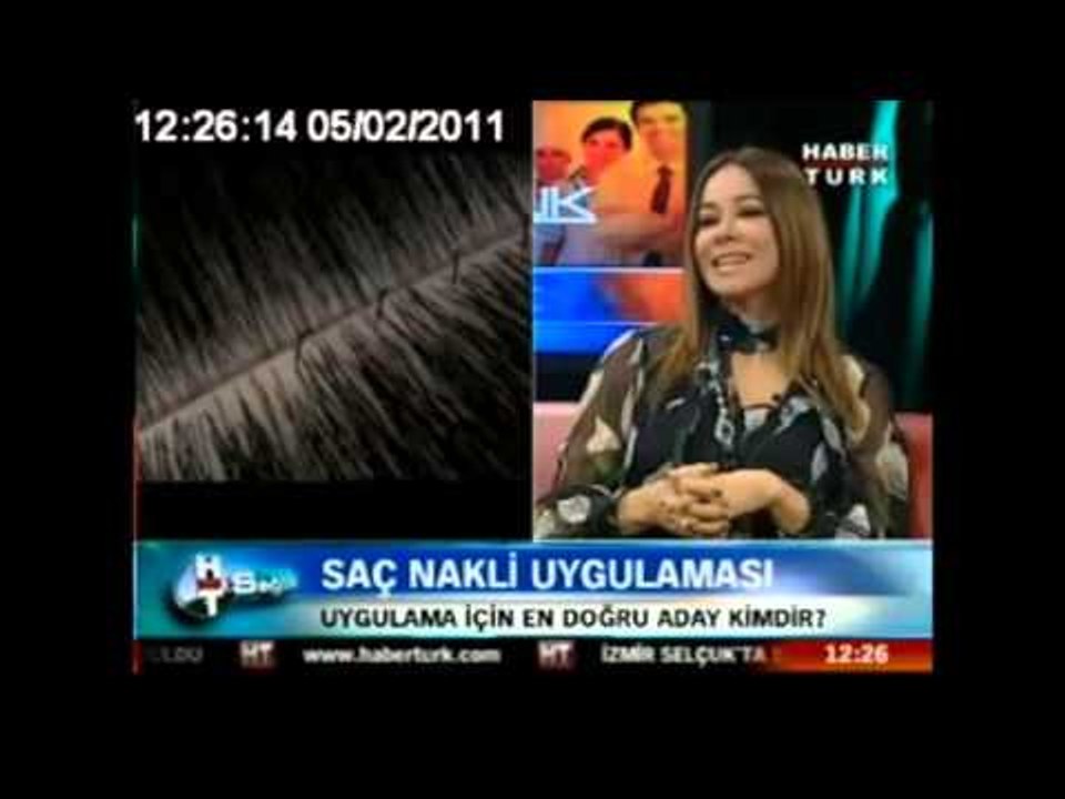 Saç nakline en uygun profili kimler oluşturur ?