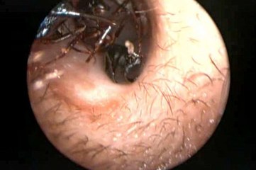 Médicos Encontram Literalmente Um ”Formigueiro” A Viver No Cérebro De Menina!