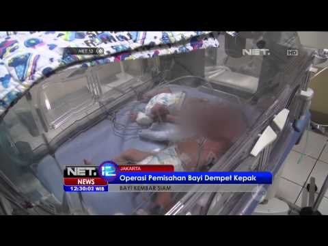 Bayi kembar Siam Jalani Operasi Pemisahan di RSPAD Jakarta - NET12