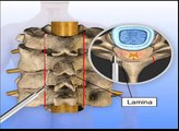 Posterior Cervical Laminoplasty Surgeon, Treatment NY