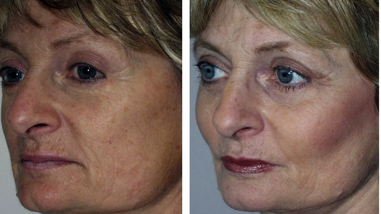 Cheek Implants