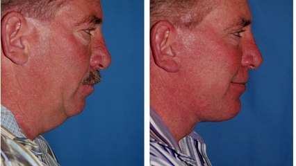 Facelift Surgery in Seattle Washington