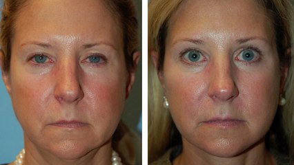 Browlift Surgery