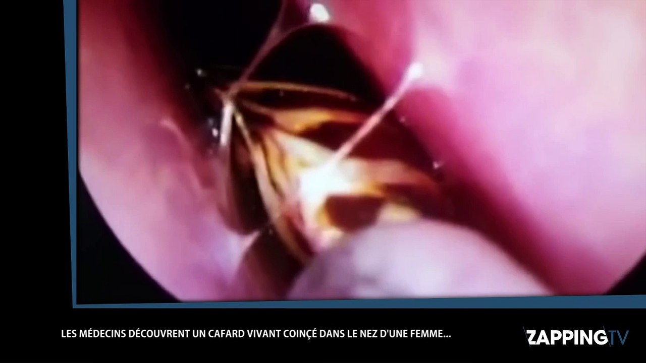 Un médecin retire un cafard du nez d’une patiente (Vidéo)