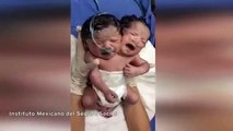 Bebé com duas cabeças nasce no México