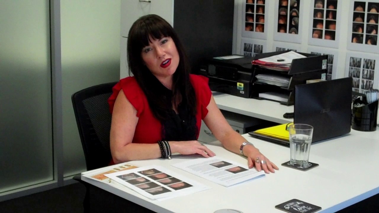 Receding Hairline Treatment Diagnosis & Results