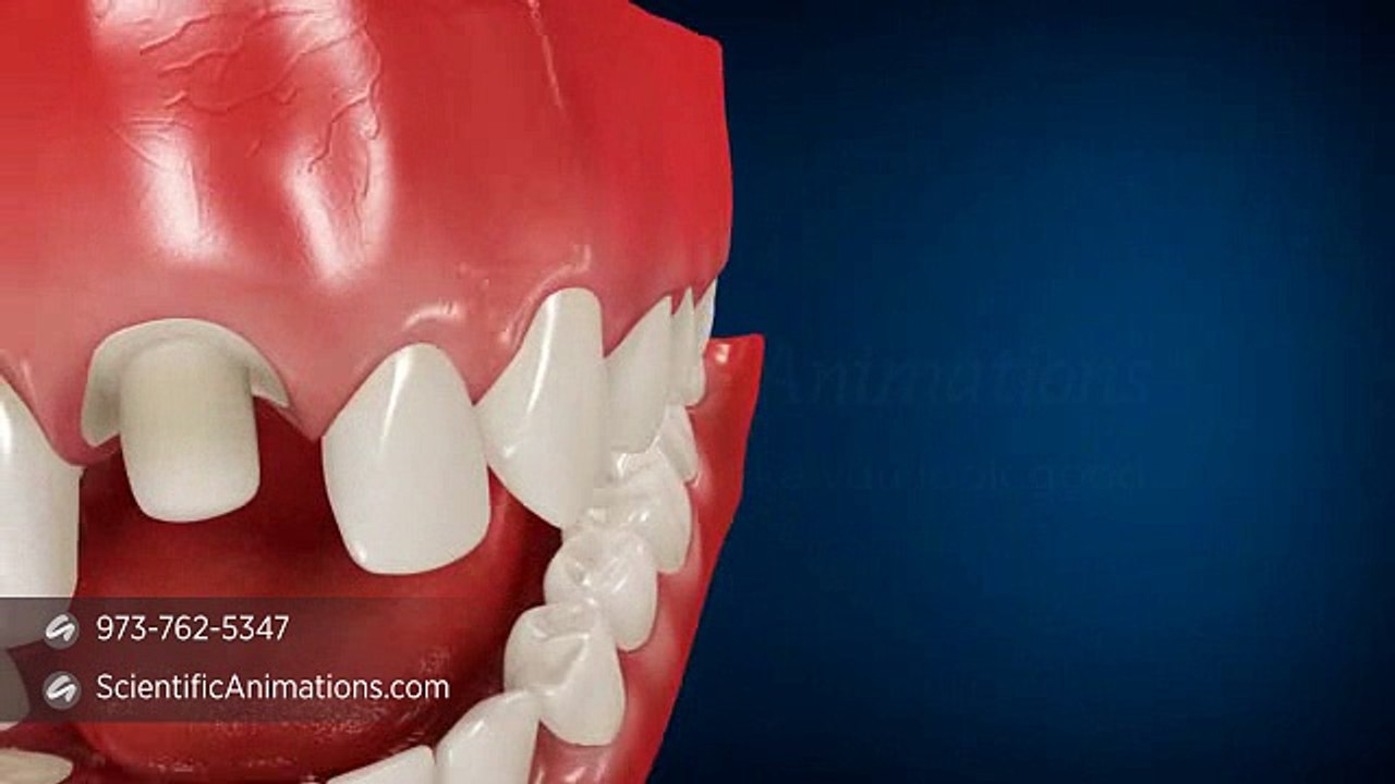Dental Restoration | Dental Crown Procedure - 3D Scientific Animations