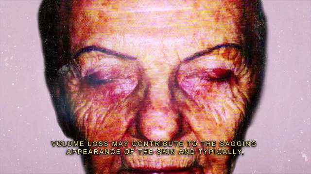 PDO Thread Lift- Skin Tightening Treatment without Surgery