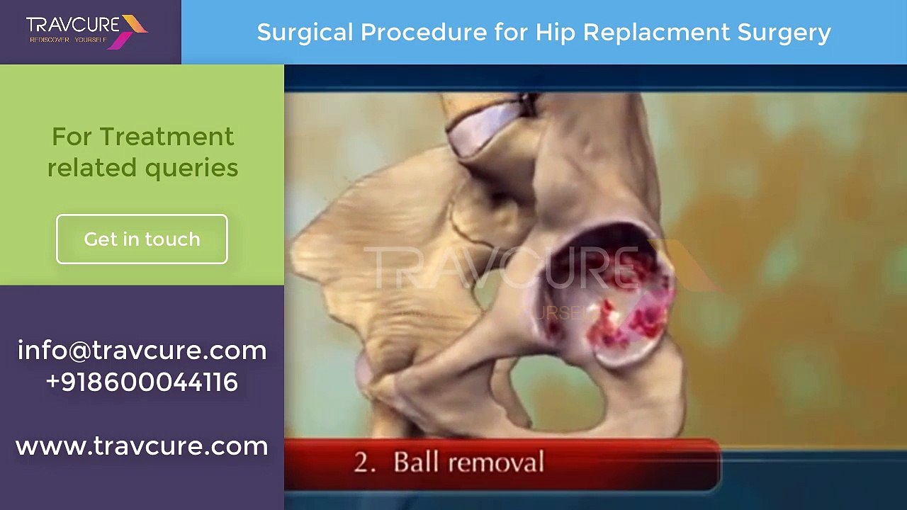 How is Total Hip Replacement Carried Out? - Animated Video by SurgeryLog