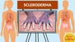 Causes Signs Symptoms Youtube Channel - Scleroderma Causes