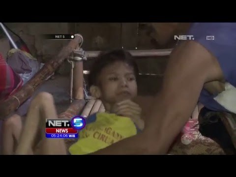 Prihatin!! Kondisi Afin yang Menderita Gizi Buruk - NET5
