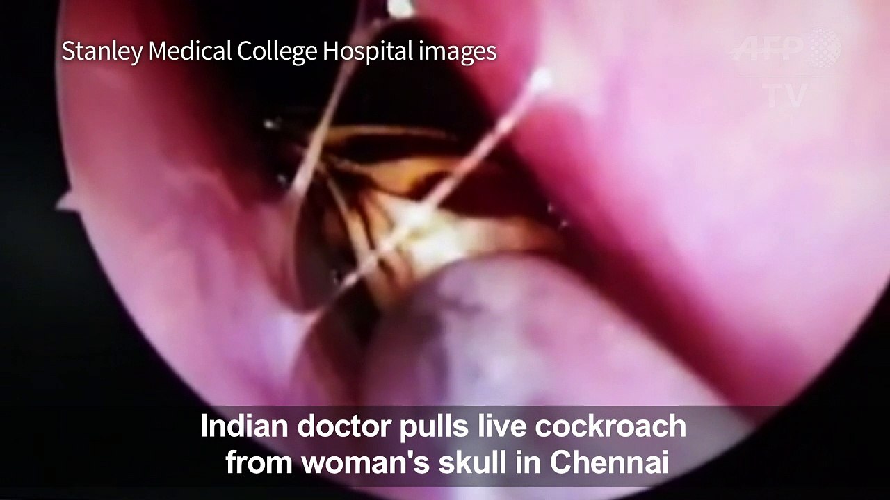 Indian doctor pulls live cockroach from woman's skull