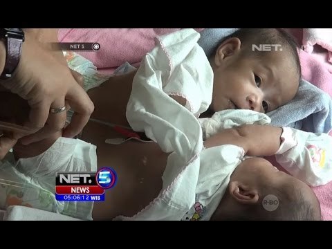 Bayi Kembar Siam Cantik Ini Akan di Operasi di RS Awal Bross Batam - NET5