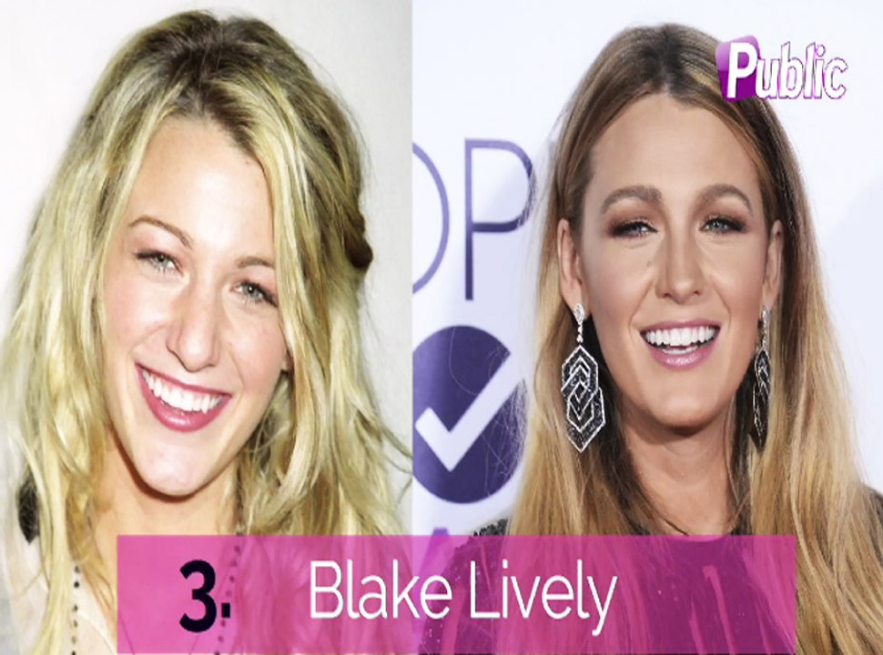 Vidéo : J.Lo, Jenifer, Blake Lively ... Elles ont eu recours à la rhinoplastie !