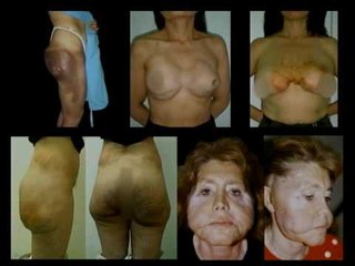 ¡Impactante! Cirugías plásticas mal realizadas