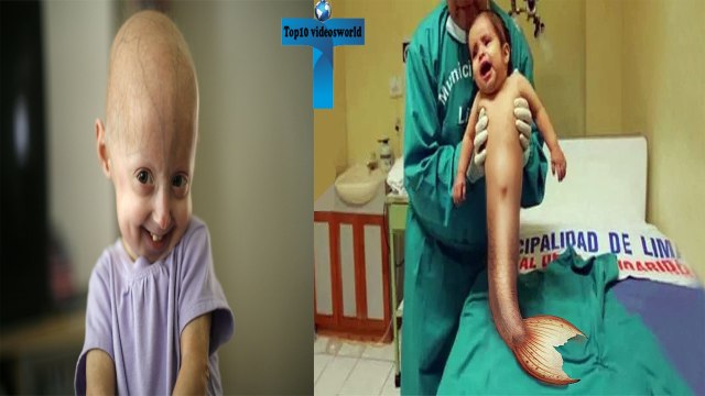 10 Unusual Genetic Mutations in Humans - Most Shocking Genetic Mutations in Peoples
