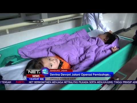 Balita Kembar Siam Jalani Operasi Pemisahan Tubuh NET12