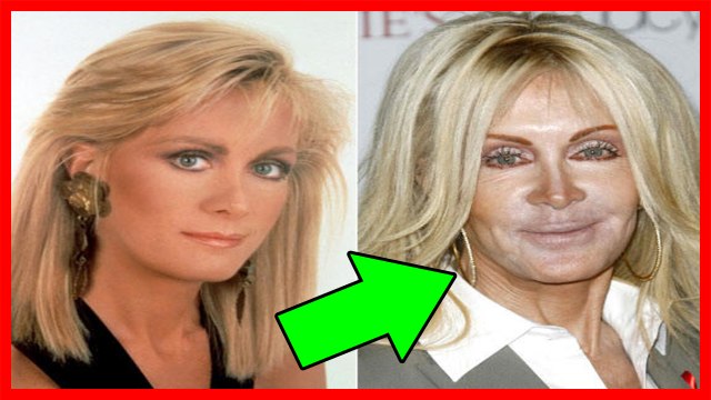 Cirurgias Plásticas Que Deram Errado Em Famosos - Pessoas Que Fizeram Plásticas - COMPLETO HD 2017