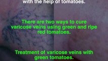 61. Amazing! With the help of a surprising home remedy Cures the varicose veins of your feet Recommend