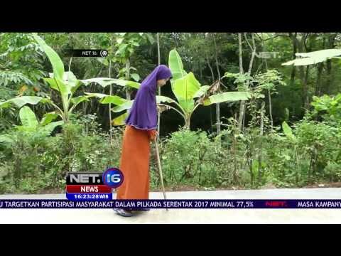 Penyakit Langka Sulami yang Dijuluki Manusia Kayu - NET 16