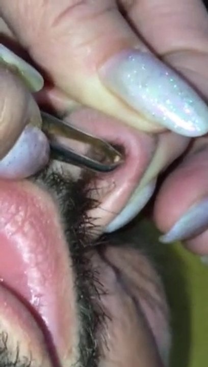 Cette femme insè son ongle dans le nez de l’. Ce qui en ressort est DÉÛ.