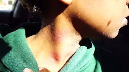 HICKEY PRANK ON BOYFRIEND GONE WRONG!!!