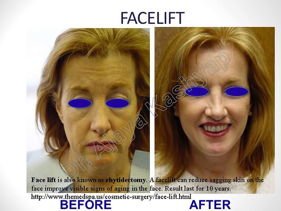 Face Surgeon : Facelift, Lip, Necklift, Nose, Rhinoplasty Surgery in Delhi, INDIA