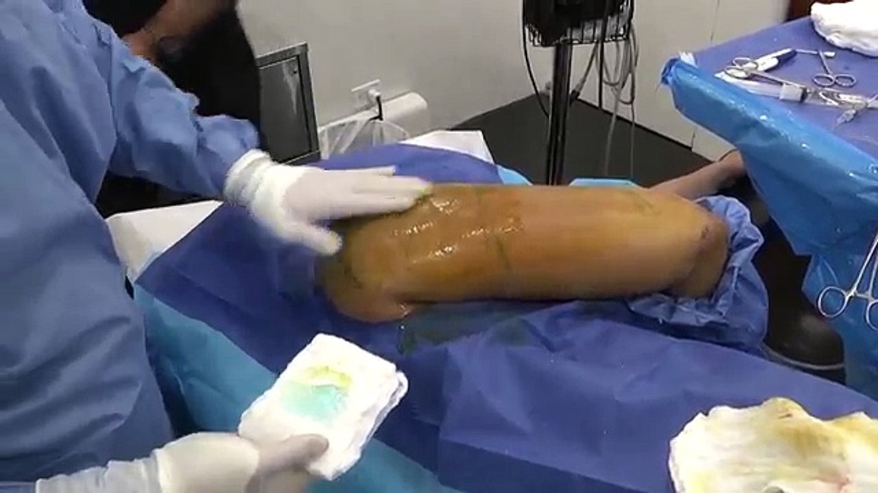 RFAL BodyTite Arm Liposuction (ArmTite) in NYC by Dr. Theodorou and Dr. Chia