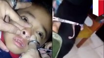 Leech pulled from boy’s nose a month after he went for a swim