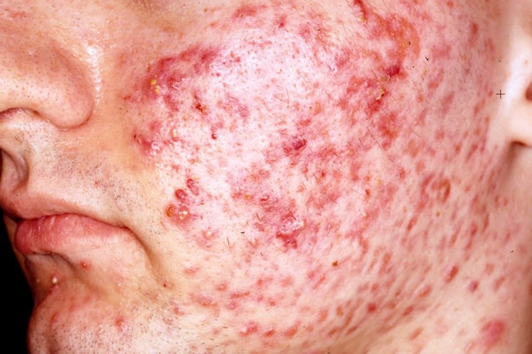 Acne Vulgaris