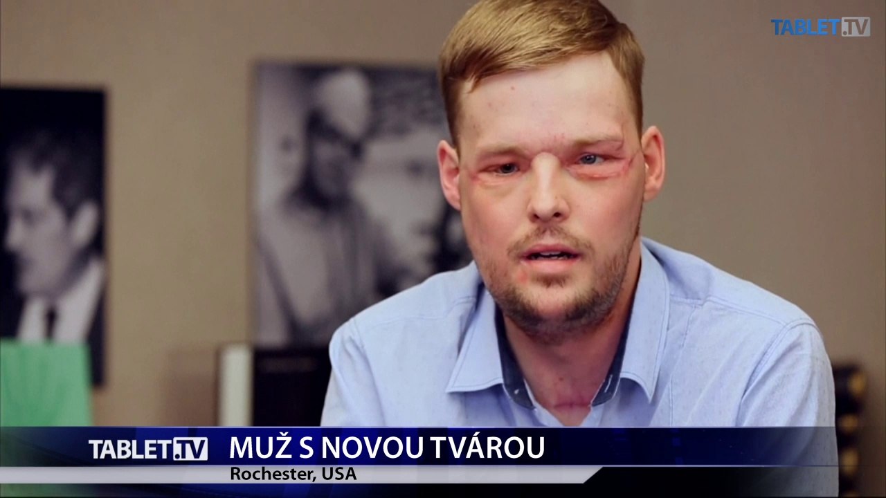 TENTO PRÍBEH NAPÍSAL ŽIVOT: Muž podstúpil transplantáciu tváre