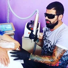 Adapazari Dovme Silimi Silenyerler Tattoo Remıval