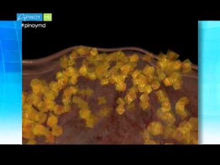 Bye, bye belly! | Pinoy MD