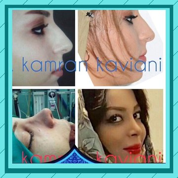 عمليات تجميل الانف في ايران (1)