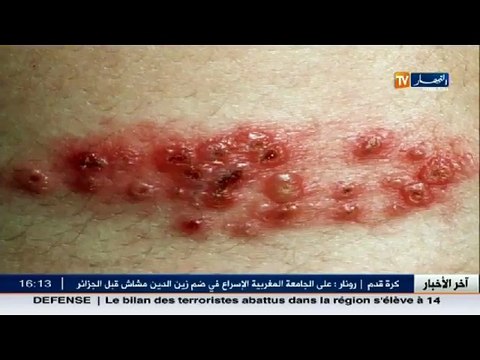 3 دقائق صحة أمراض الجلد .. جدري الماء مسبباته والوقاية منه